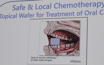 Poster showing an in-mouth wafer to treat oral cancer